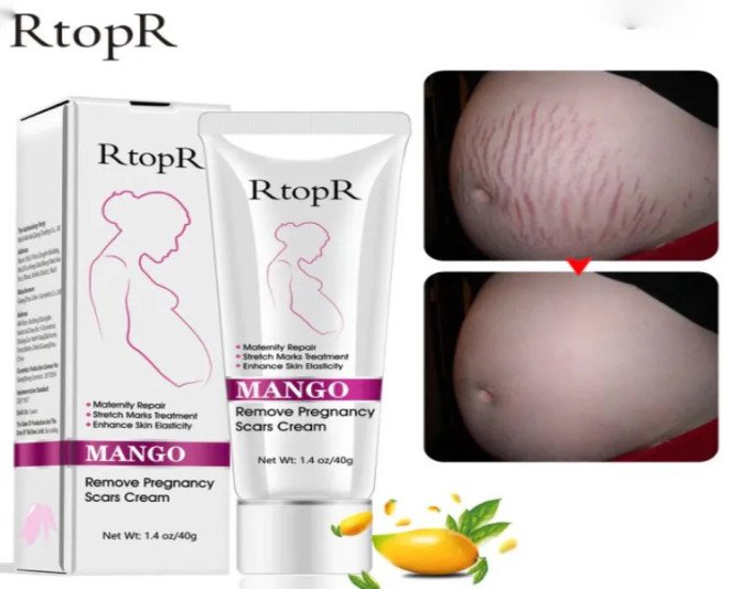 RtopR Mango Stretch Mark Cream